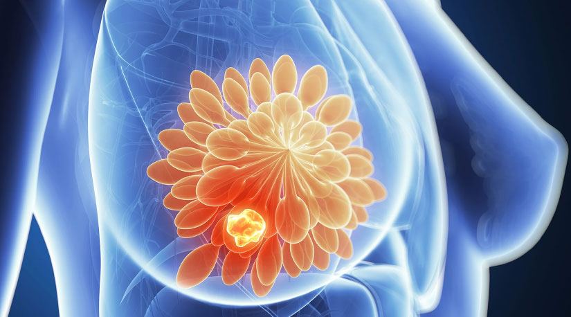 कसरी हुन्छ स्तन क्यान्सर? यसबाट कसरी बच्न सकिन्छ?